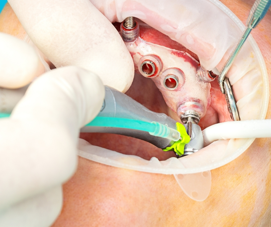 تصميم علاجي رقمي للزرع (Guided Surgery)