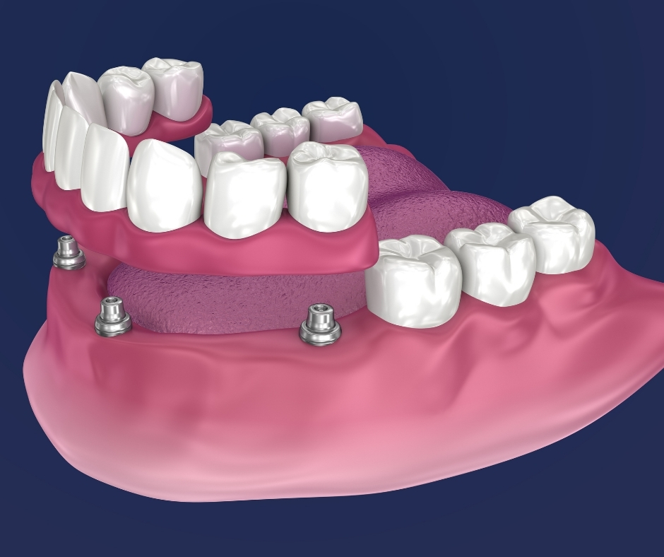 زرع إسفنجي للنسخ الصغير (Mini Implants)