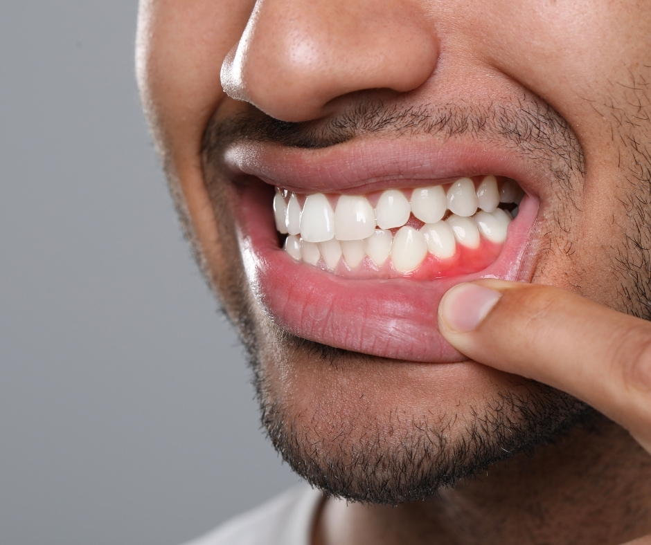 تصحيح محاذاة الأنسجة للحصول على خط لثة مثالي